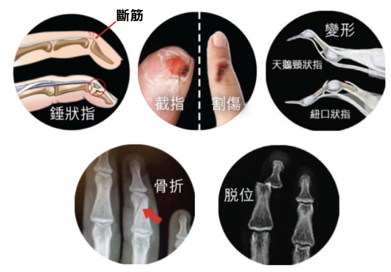 Other hand injuries gallery